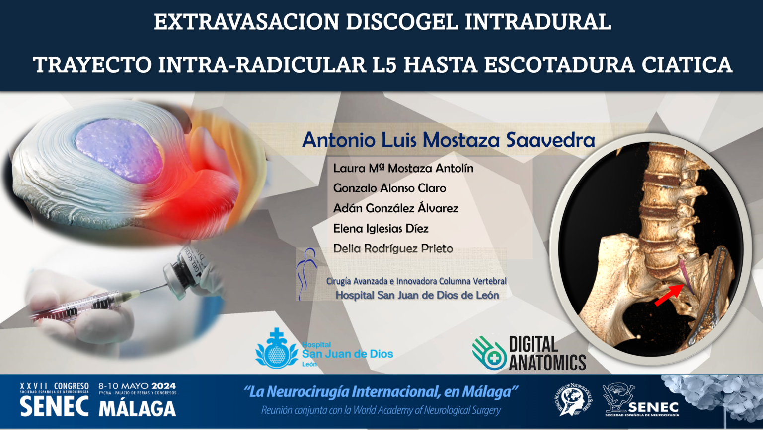 Discogel Tratamientos con Discogel® y la efectividad de la cirugía endoscópica ...