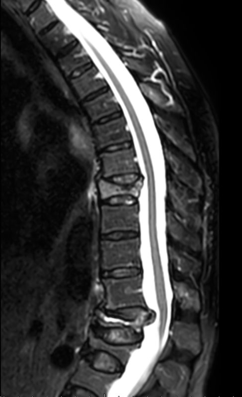 IMG.- 1fractura toracolumbar osteoporótica